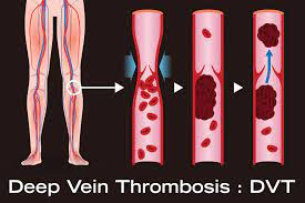 Deep vein Thrombosis: a clot in the leg.