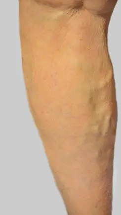 Varicose Veins in the right leg